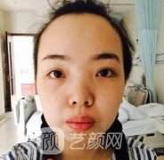 凸嘴矫正效果图片分享，