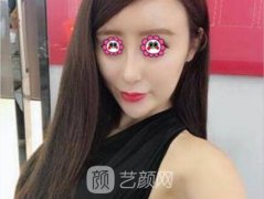 做酒窝7天恢复图|酒窝再造