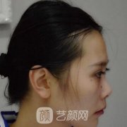 鼻综合术后1-7天的照片分