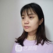 上海李元山隆鼻案例：表