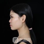 华西卿勇鼻综合案例：鼻