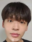 男士综合隆鼻案例：男孩