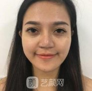 人造酒窝前后对比照片-人