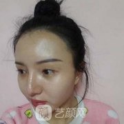 石家庄美联臣双眼皮案例