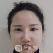 首尔丽格崔荣达颧弓内推