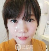 眼睛泪沟脂肪填充案例：