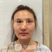 颧弓内推前后对比照片-真