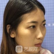 上海丽铂整形玻尿酸隆鼻