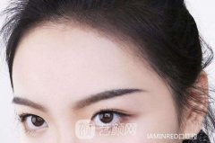 发际线往上移怎么办?做发际线种植会有作用吗?