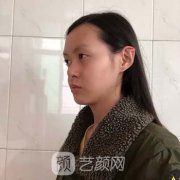 鼻头肥大矫正术案例：精