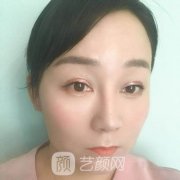 瘦脸针真实案例|手术前后
