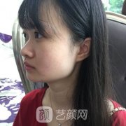 瘦脸针效果图前后对比|瘦