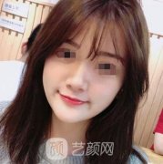 玻尿酸丰唇珠前后比照|玻
