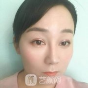 打瘦脸针效果图片对比：