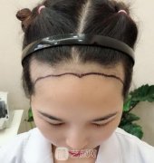 女性毛发种植效果图分享