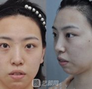 玻尿酸垫下巴前后对比效