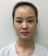 开眼尾前后对比效果照片