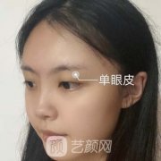 蒋海军双眼皮案例，双眼