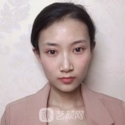北京靳小雷双眼皮修复专
