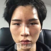 男生6mm双眼皮恢复案例，