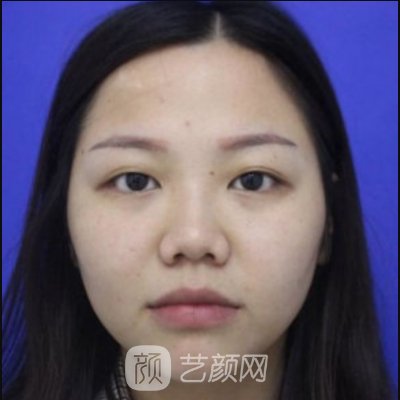北京隆鼻手术真实案例一