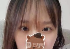 陈辉双眼皮修复案例，修