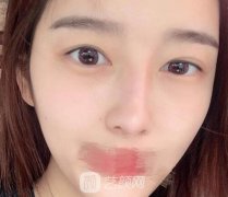 潘勇双眼皮修复案例，内