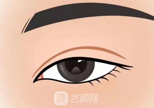 北京王偲双眼皮费用高吗