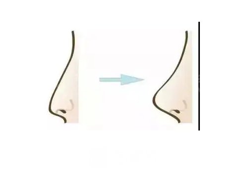 菲林普利隆鼻能维持多久