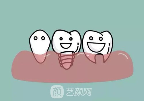 韩国美格真种植体的优缺