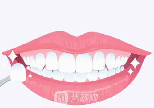 铸瓷贴面和全瓷贴面价格