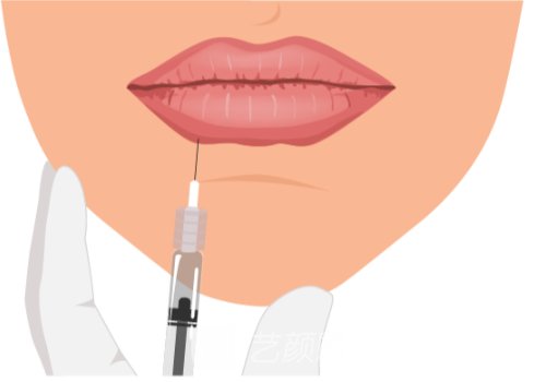 莫娜丽莎玻尿酸适合打唇