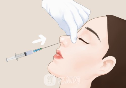 少女针填充鼻子能维持多