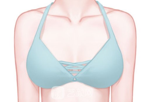 人工韧带乳房提升术可以