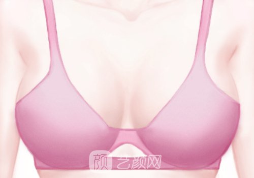 艾斯美假体价格是多少?优