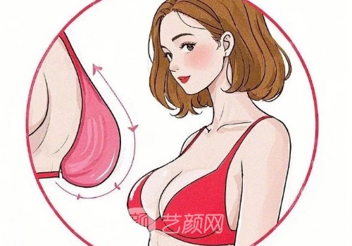 艾斯美假体和曼托假体哪