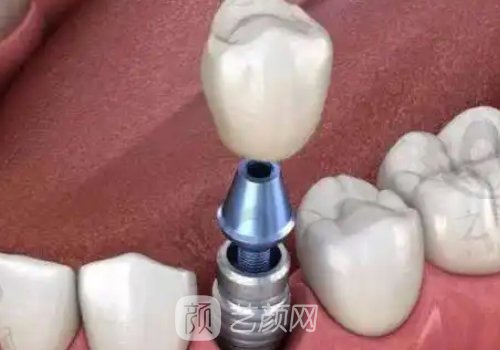 皓圣种植牙价格多少钱一