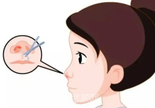 成都许智隆鼻价格是多少