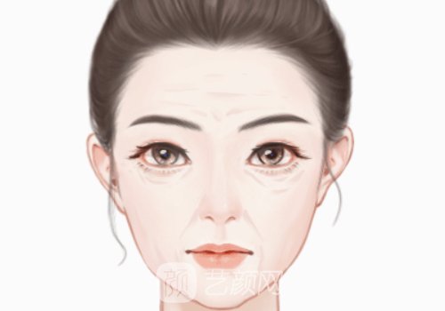 双矢量提升术和筋膜悬吊