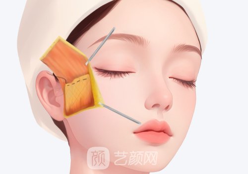 上海颏成型手术可以部分