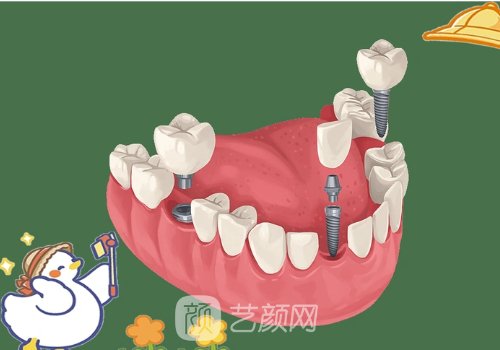 合肥医院种植牙价格贵吗