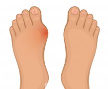 脚骨拐矫正需要多少钱？