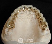 纯钛金属牙齿好不好？当