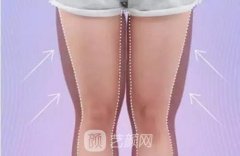 大腿内侧吸脂多久恢复？