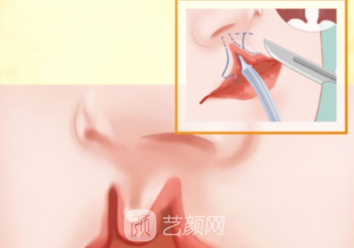 兔唇修补是国家免费吗?技