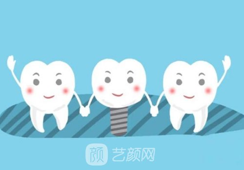 法国安卓健种植牙是什么