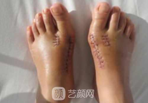 脚骨拐矫正需要多少钱?价