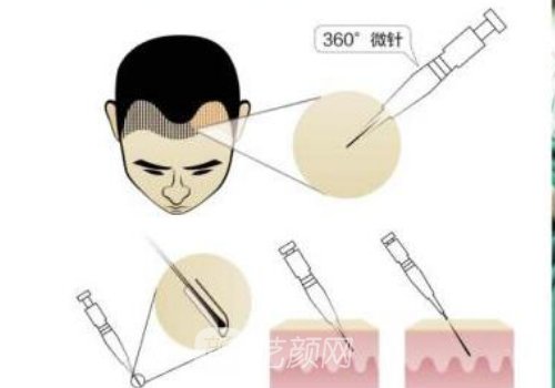 广州毛发种植多少钱?医院