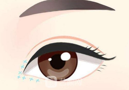 做双眼皮开眼角失败案例