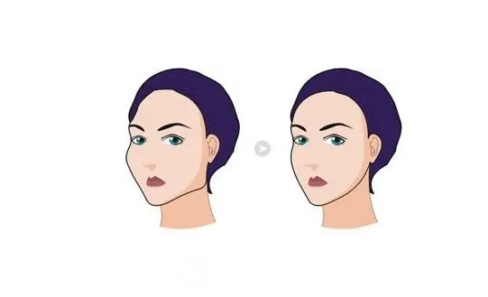 内推颧骨手术多少钱?3万够